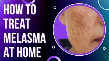 Melasma: Causes, Symptoms, and Treatment