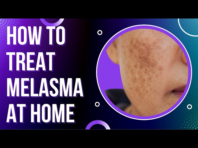 Melasma: Causes, Symptoms, and Treatment | SchoolTube