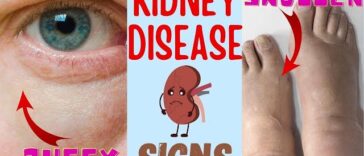 Understanding Kidney Failure: Causes, Symptoms, and Treatment