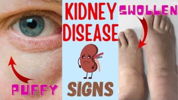 Understanding Kidney Failure: Causes, Symptoms, and Treatment