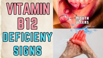 Vitamin B12 Deficiency: Unveiling the Hidden Health Culprit